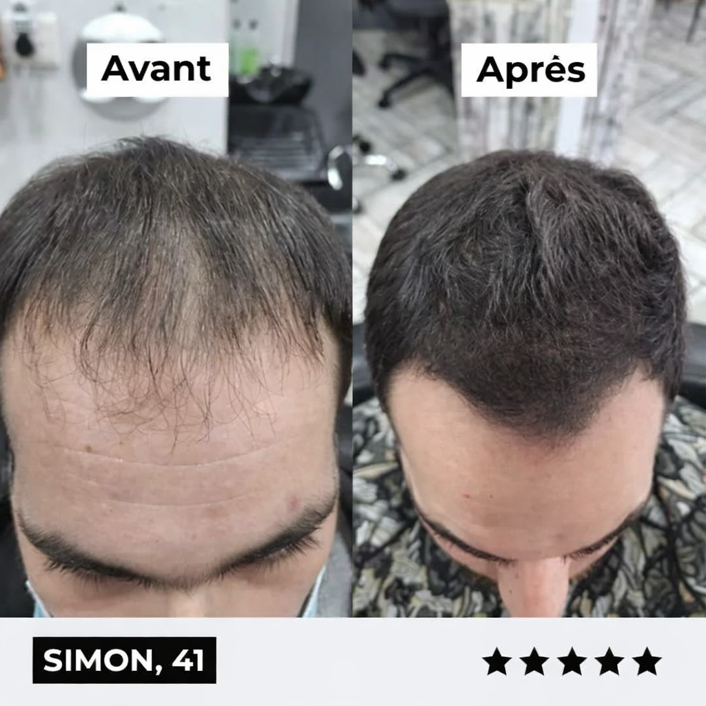 Micro-Infusion Density Pro+®